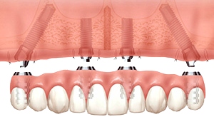 Same Day Full Teeth Replacement